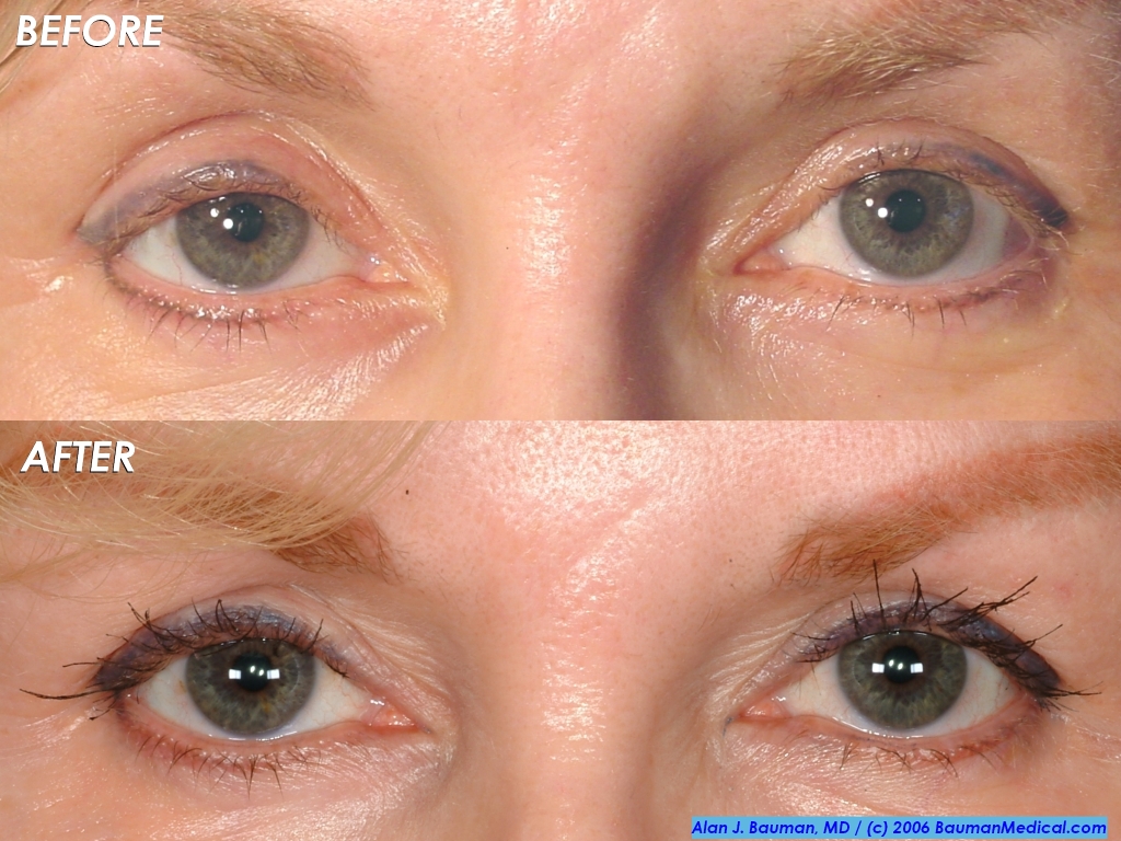 Pictures Of Eyelash