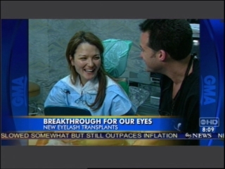 Video: Dr. Bauman On Abc'S Good Morning America Discussing Eyelash Transplants