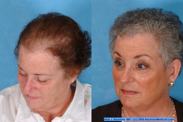 Ny Times: Female Hair Loss - -