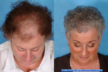 Treatments For Female Hereditary Hair Thinning Are Available