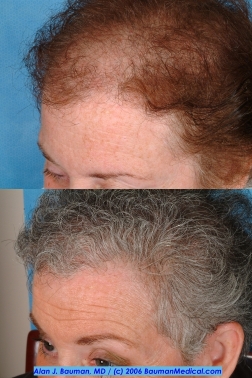 Ny Times: Female Hair Loss - -