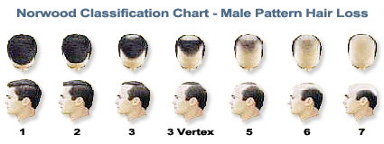 Male Pattern Baldness - -