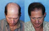 Usa Today Article On Hair Restoration Vacation - -