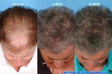 Treatments For Female Hereditary Hair Thinning Are Available