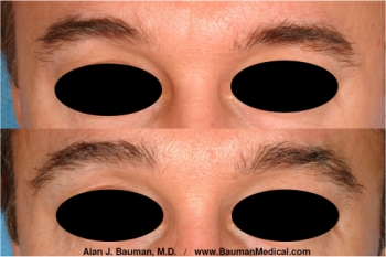 Before And After Male Eyebrow Transplant By Dr. Bauman (Click For Larger Photo) Eyebrow Transplant Transplantation By Dr Alan Bauman Florida Before After