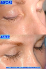 Before And After Eyelash Transplantation By Dr. Bauman