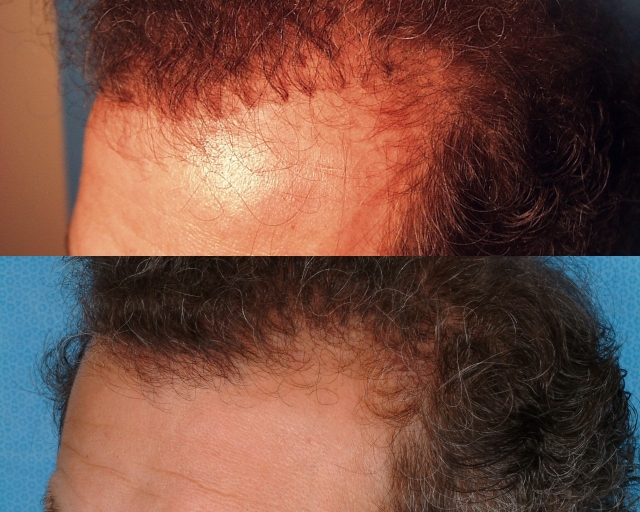 Hair Transplant Repair - -