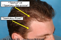 The 'Temporal Point' Is Located Between The Temporal (Or Temple) Recession And The Sideburn Areas