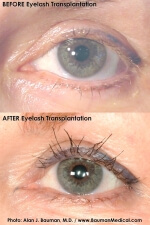 Bauman-Eyelash-Transplant-Left-Eye