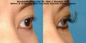 Eyelash-Transpant-Before-After-Open