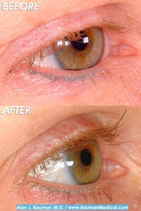 Before And After Eyelash Transplant By Dr. Alan Bauman