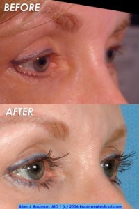 Eyelash-Transplant-Female-Elderly-Side