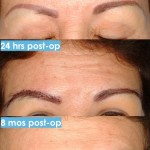 Eyebrow Transplant Procedure