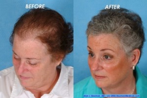 Female-Hair-Transplantation-Side-Right