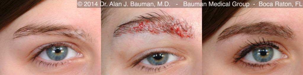 Female-Eyebrow-Transplant-Scar_Dralanbauman_Pre+24Hr+12Mo