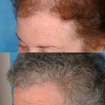 Hair-Transplant-Female-Before-After-Left-Side