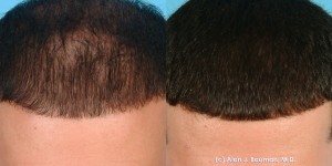 Prp Hair Regrowth Treatment Results From Dr Alan Bauman