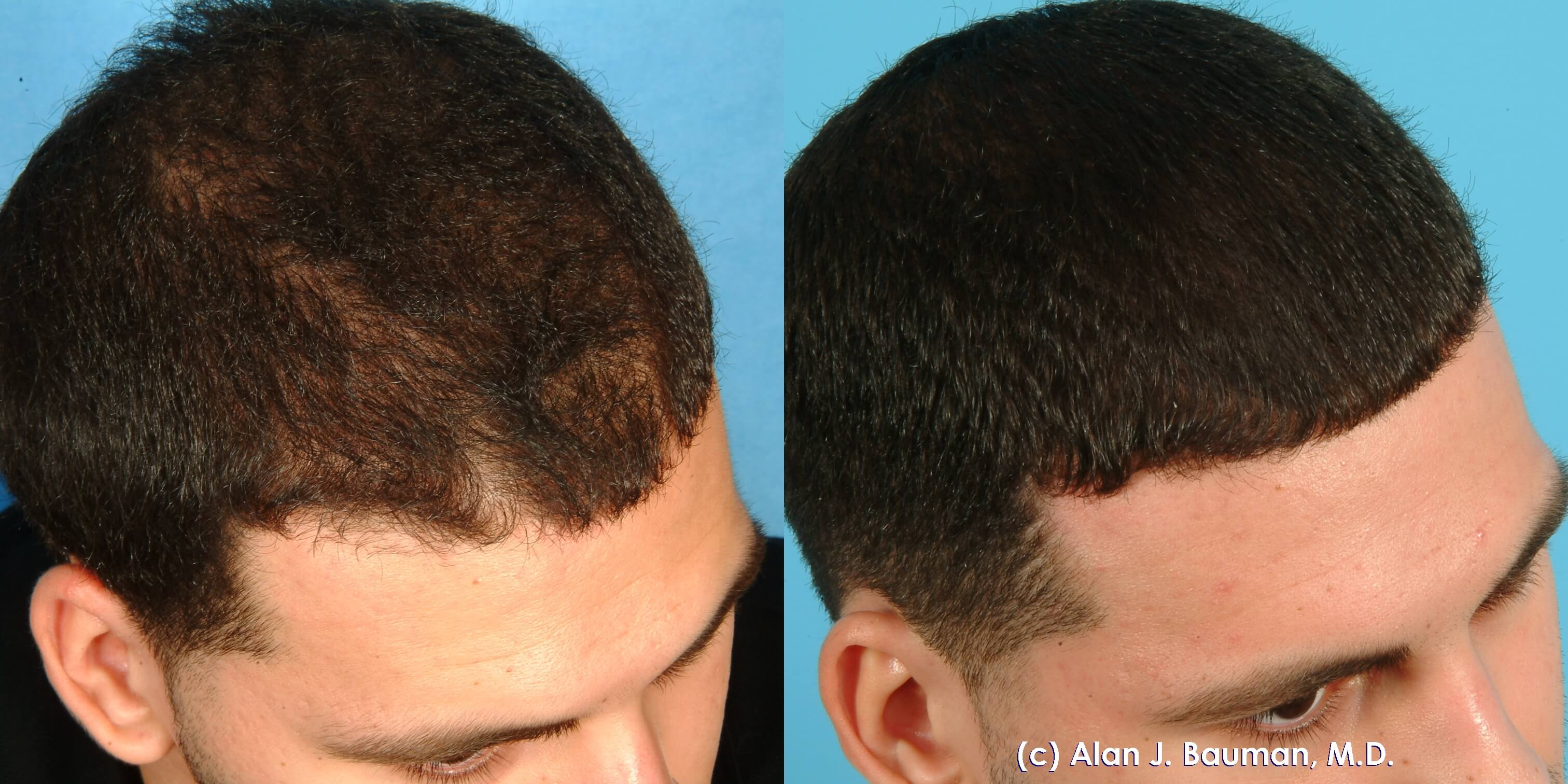 FUE and PRP result  3517 grafts  AlviArmani  Hair Transplant Los Angeles