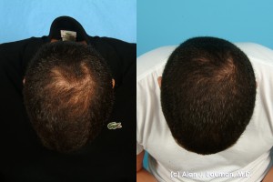 Prp Hair Regrowth Treatment Results From Dr Alan Bauman