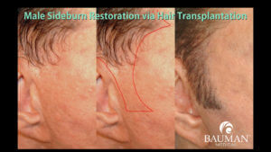 Dr Alan Bauman Becky-Plastic Surgery Hair Loss.male.sideburn