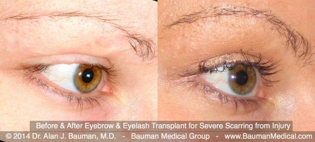 Eyebrow+Eyelash-Scar-Transplant_Dralanbauman