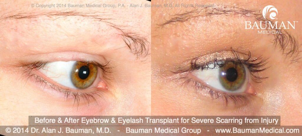 Before After Eyelash Eyebrow Scar Transplant Implant Dr Alan Bauman