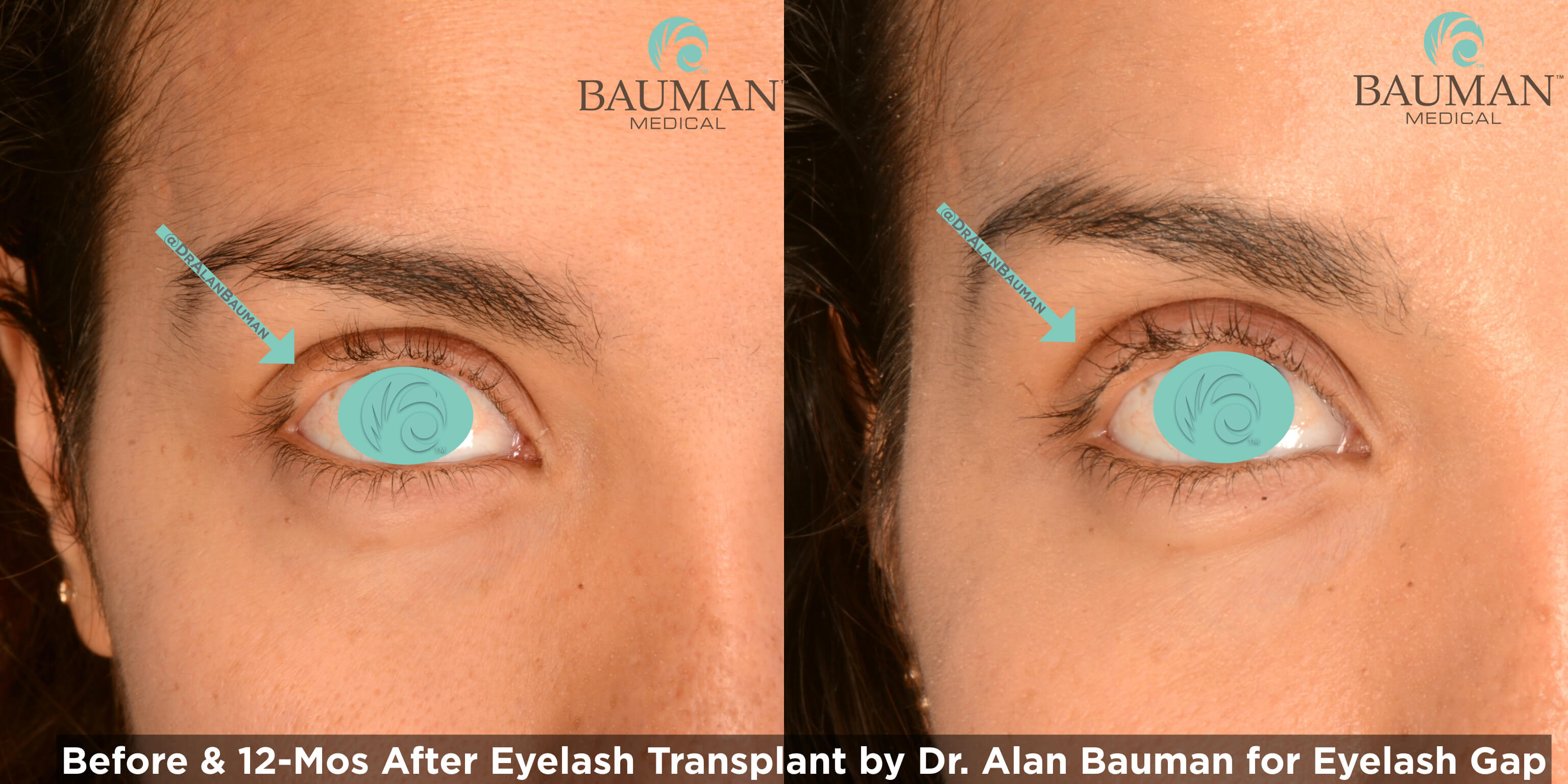 https://www.baumanmedical.com/wp-content/uploads/2014/05/eyelash-gap-photos-before-after.002.jpeg