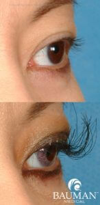 Eyelash_Transplant_Implant_Extreme_Lashes2_Dr Alan Bauman