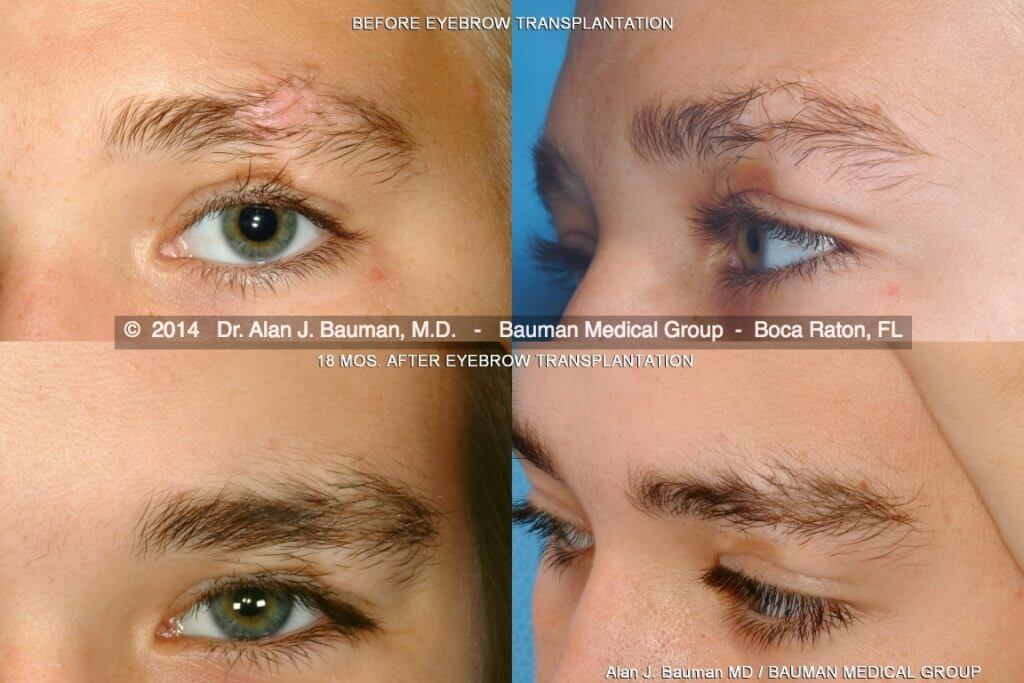 Male-Eyebrow-Scar-Transplant-Dralanbauman Eyebrow Transplant Transplantation Scar By Dr Alan Bauman Florida Before After