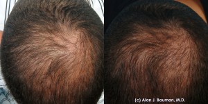 Prp Hair Regrowth Treatment Results From Dr Alan Bauman