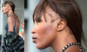 Naomi-Balding-Traction-Alopecia