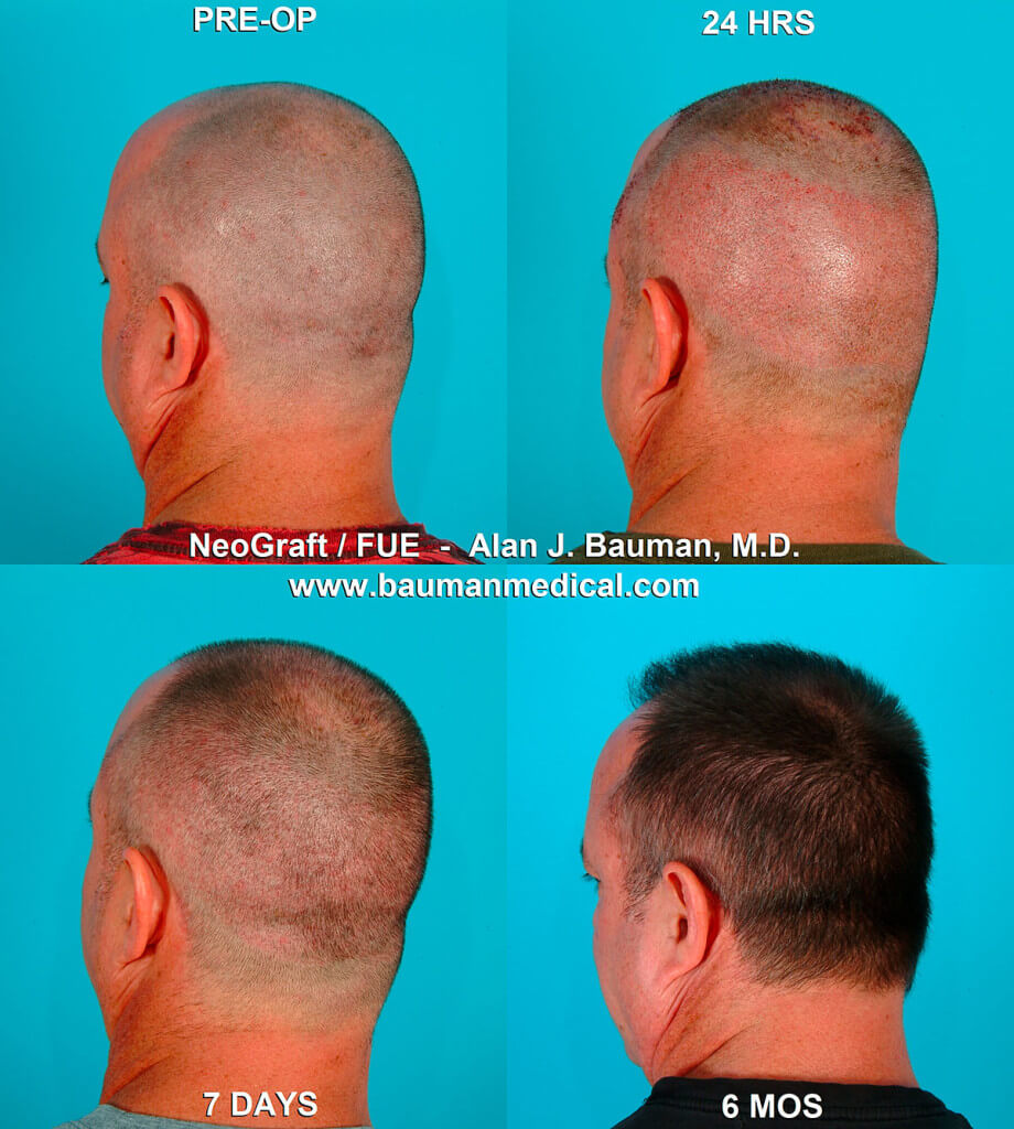 Neograft-Fue-Hair-Transplant