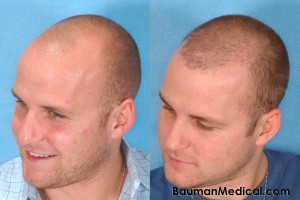 Bald-Head-Hair-Restoration