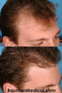 Before-Temporal-Hair-Restoration