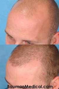 Beforehairrestoration