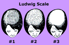 Different-Stages-Of-Women-With-Thinning-Hair