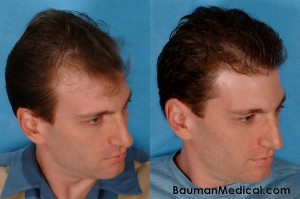 Hair-Restoration-Before-And-After