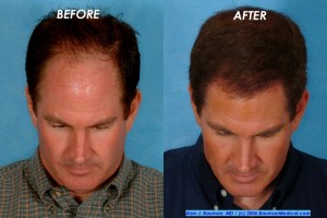 Hair-Restoration-Jim-Abath-2