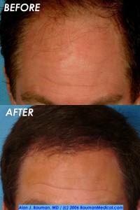 Hair-Restoration-Jim-Abath-3