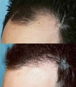 Patient-Picture-Hair-Graft-Transfer