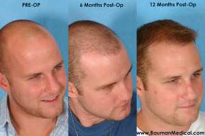 Stageofhairrestoration-Dr-Bauman