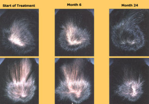 Stages-Of-Propecia