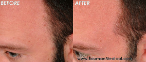 Temporal Point Restoration Photos: Hair Transplant Artistry Temporal-Point-Before-Dr-Bauman
