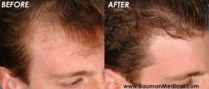 Temporal-Point-Hair-Restoration2