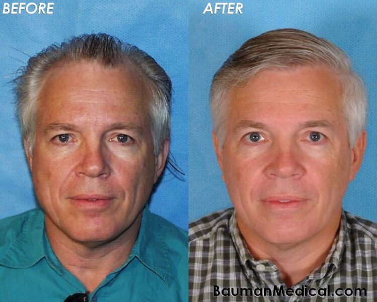 50 y/o Male Hair Transplant Results