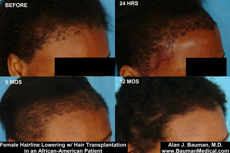 African-American Female Hair Transplant Results