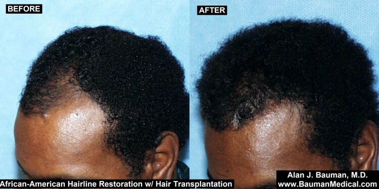 African-American Male Hair Transplant Results