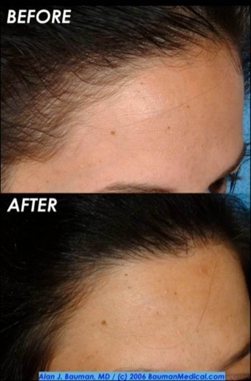 30 y/o Female Hair Transplant Results