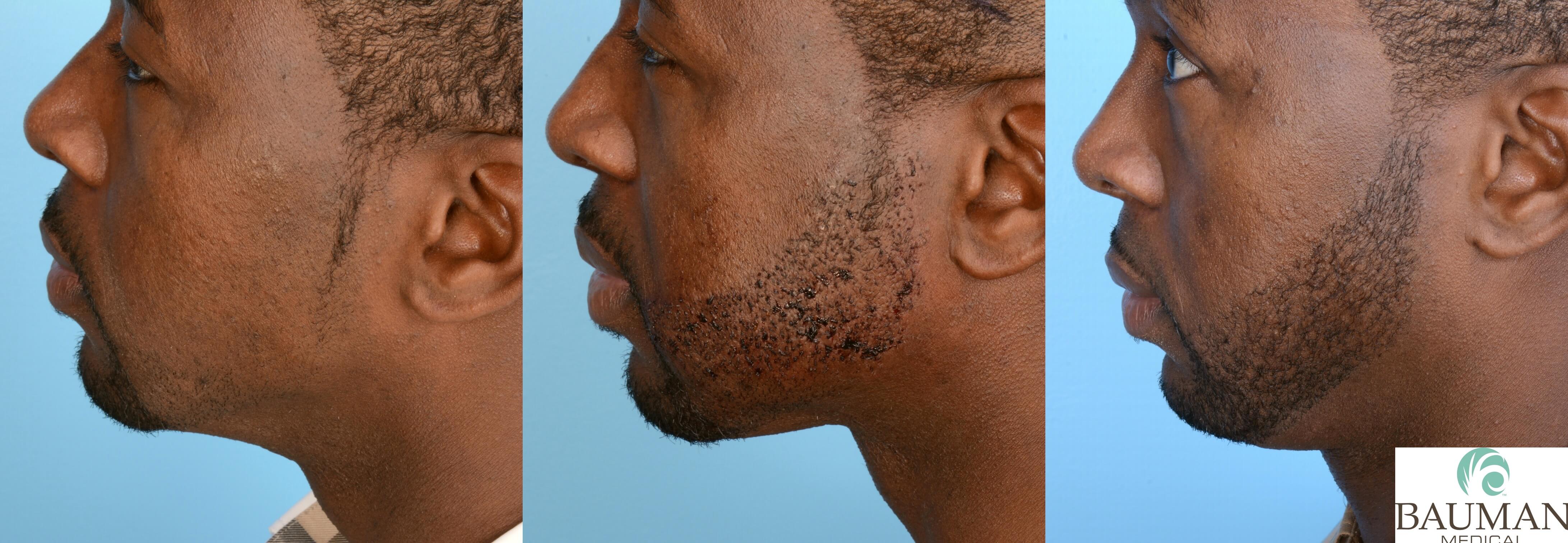 Beard & Mustache Transplantation Results · Bauman Medical