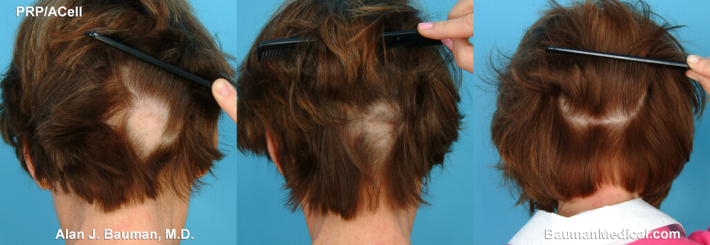 Prp Hair Regrowth Picture Female Alopecia Areata Patient Doctor Bauman Medical Group